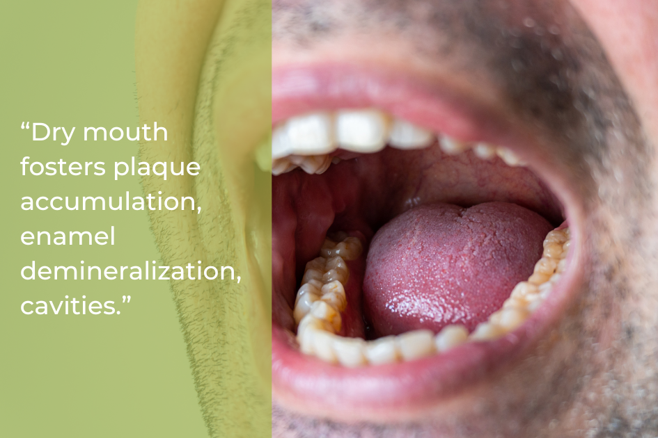 Close-up of an open mouth showing teeth and tongue, with a text overlay about dry mouth causing plaque, enamel demineralization, and cavities.